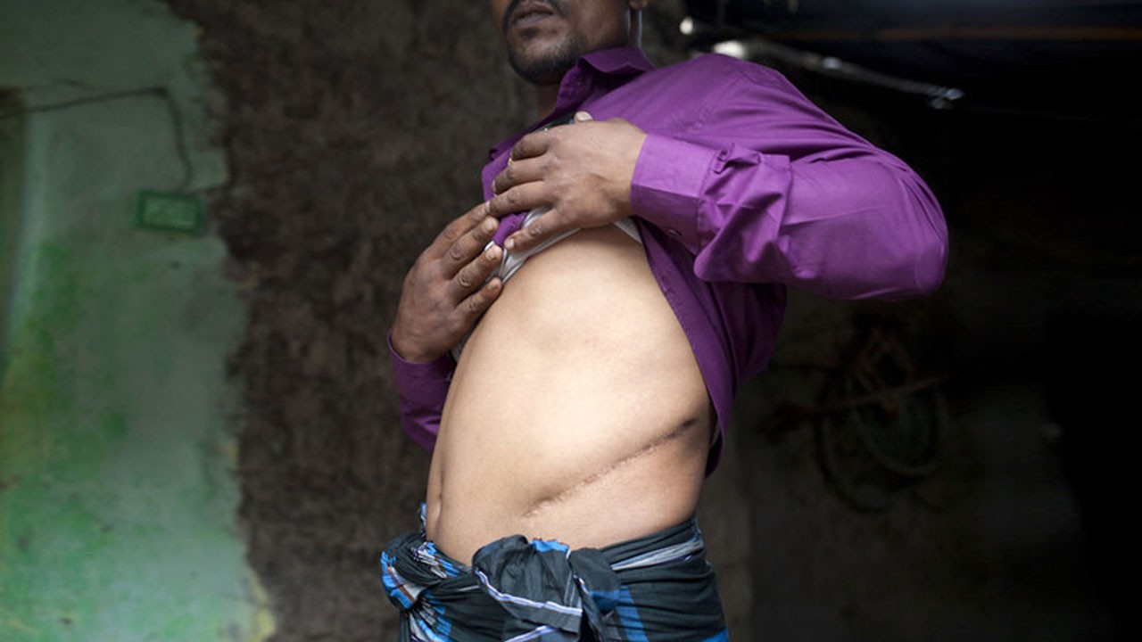 ভারতে গিয়ে কিডনি হারালেন ৩ বাংলাদেশি !